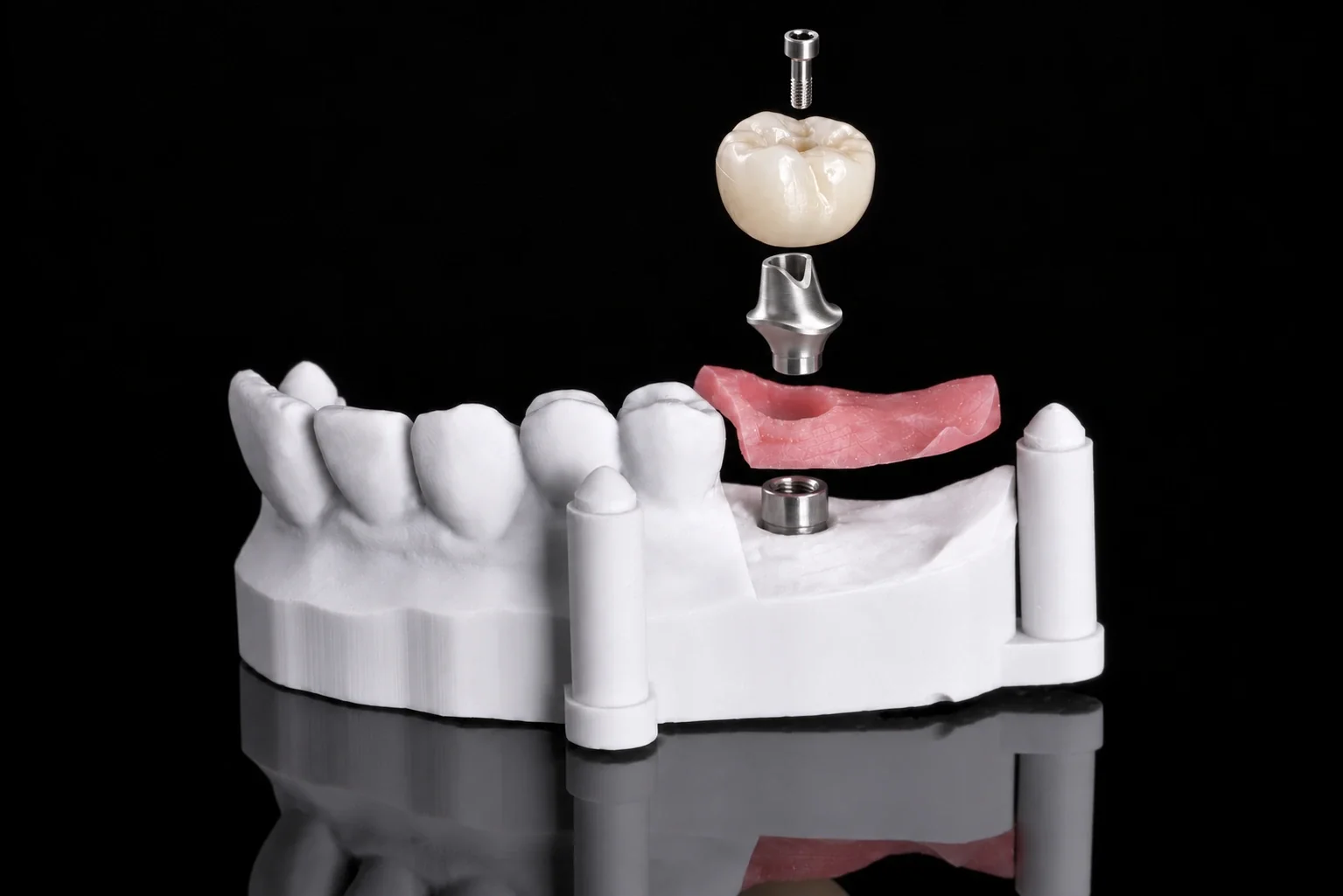 Exploded view of a zirconia crown, retaining screw, and custom abutment on a dental model