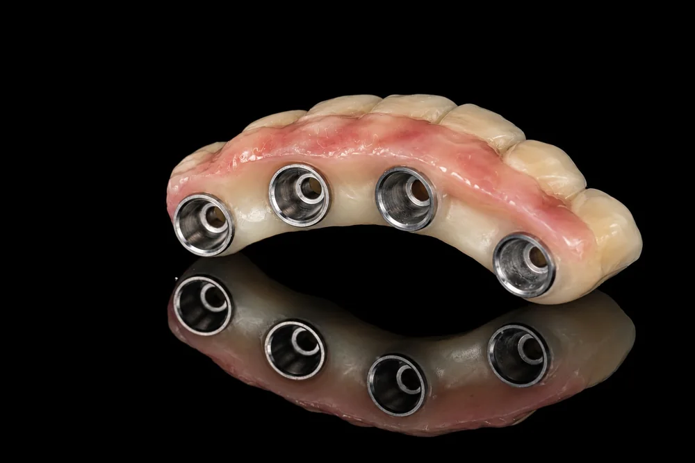 Implant Restoration · Underside