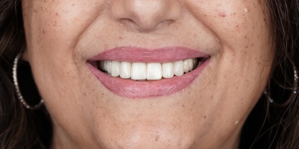 Frontal smile with zirconia restorations