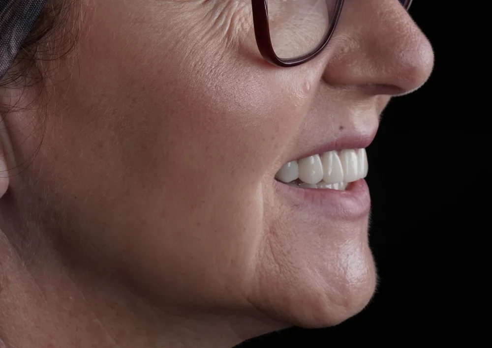 Side view of a smile with zirconia restorations